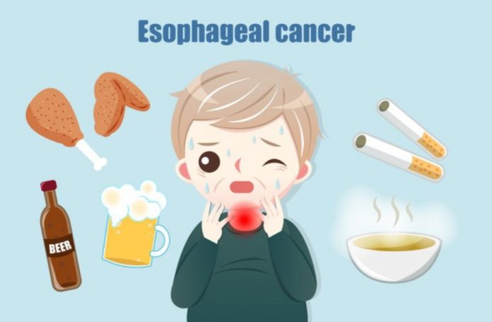 Esophageal cancer